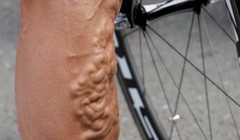 Varicose veins in cyclists