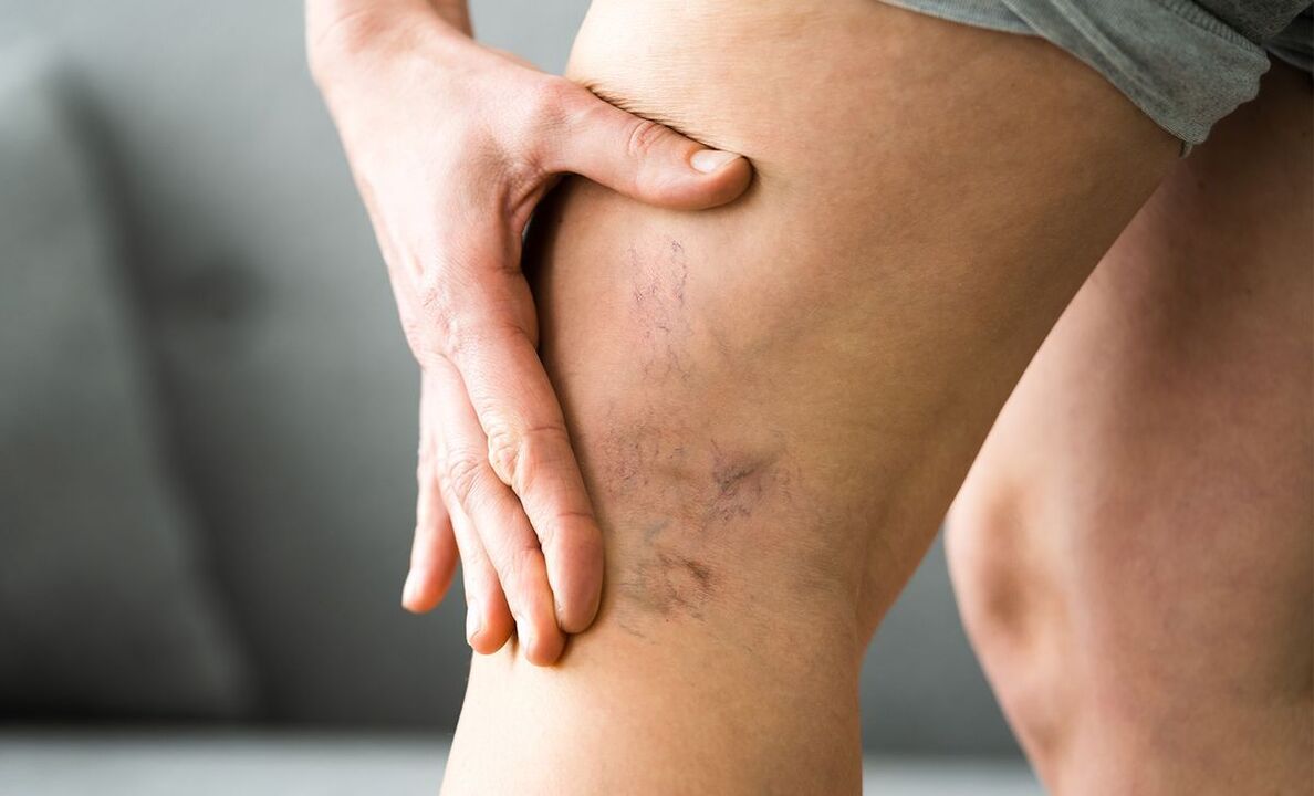 signs of varicose veins