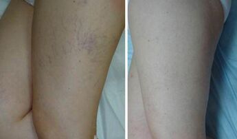 veins before and after gel application